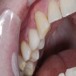 Teeth Crown Specialists in Bousd 7