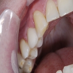 Dental Implants Process in Broom 2