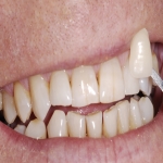 Teeth Crown Specialists in Knighton 3