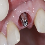 Tooth Restoration Treatment 5