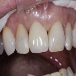 Invisalign Clear Braces in Cottown 12