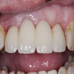 Single Teeth Implant in Ashton 3