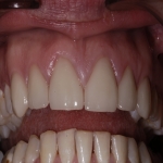 Teeth Crown Specialists in Ballydonegan 9