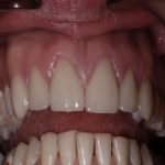 Artificial Teeth Veneers in Ashley 10