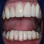 Complete Teeth Implants in Middleton 6