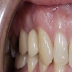 Tooth Shaping Treatment in Ashley 8