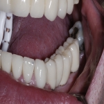 Dental Implants Process in Milltown 2