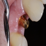 Single Teeth Implant in Woodend 4