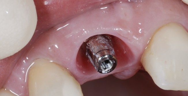 Tooth Implant Procedure in Newton