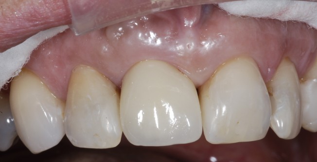 Dental Implants Treatment in Broom