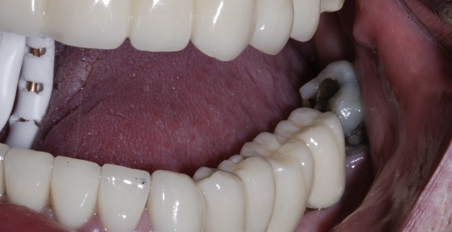 Teeth Replacement Treatment in Church End