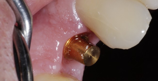 Fitting Implanted Teeth in Stockton