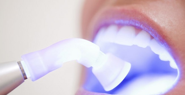 Laser Teeth Whitening in Ansty